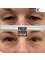 Kenneth Kok Plastic Surgery Clinic - Upper eyelid lift 