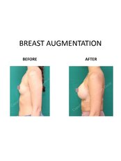 Breast Implants - Dr Ananda 's Cosmetic Surgery Clinic