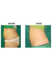 Liposuction - Dr Ananda 's Cosmetic Surgery Clinic