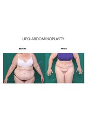Tummy Tuck - Dr Ananda 's Cosmetic Surgery Clinic