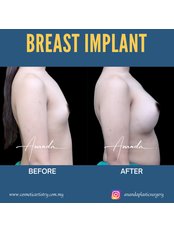 Breast Implants - Dr Ananda's Cosmetic Surgery Clinic