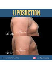 Liposuction - Dr Ananda's Cosmetic Surgery Clinic