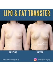 Fat Transfer - Dr Ananda's Cosmetic Surgery Clinic