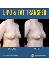 Fat Transfer - Dr Ananda's Cosmetic Surgery Clinic