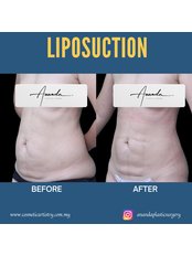 Liposuction - Dr Ananda's Cosmetic Surgery Clinic