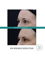 Wrinkle Reduction - NextMed Clinic PJ