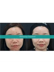 Acne Treatment - NextMed Clinic PJ