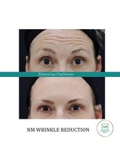 Wrinkle Reduction - NextMed Clinic PJ