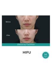 HIFU - High-Intensity Focused Ultrasound - NextMed Clinic PJ