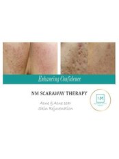 Scar Removal - NextMed Clinic Setia Alam
