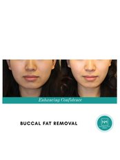 Buccal Fat Removal - NextMed Clinic Setia Alam