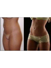 Liposuction - REJUVE PLASTIC SURGERY by Dr. Edgar Torres