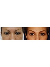 Eyelid Surgery - REJUVE PLASTIC SURGERY by Dr. Edgar Torres