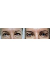 Eyelid Surgery - REJUVE PLASTIC SURGERY by Dr. Edgar Torres