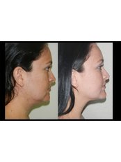 Neck Liposuction - REJUVE PLASTIC SURGERY by Dr. Edgar Torres