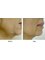 Dr. Manlio Speziale - Before and After of Radiofrecuency Face Treatment Accent XL 