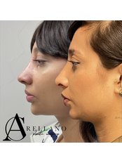 Rhinoplasty - Arellano Plastic Surgery