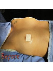 Breast Implants - Arellano Plastic Surgery
