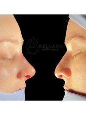 Rhinoplasty - Arellano Plastic Surgery