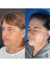 Facelift - Arellano Plastic Surgery