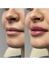Lip Filler - Arellano Plastic Surgery