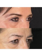 Eyelid Surgery - Arellano Plastic Surgery