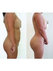 Liposuction - Clínica Dermatológica y Cirugía Estética de Puebla