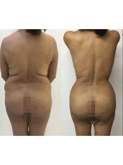 Fat Transfer - Clínica Dermatológica y Cirugía Estética de Puebla