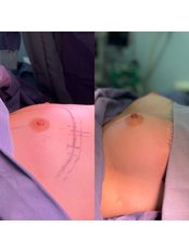 Breast Implants - Dr Uriel Muñoz Plastic Surgeon