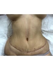 Tummy Tuck - Dr Uriel Muñoz Plastic Surgeon