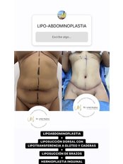 Tummy Tuck - Dr Uriel Muñoz Plastic Surgeon