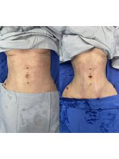 Liposuction - Dr Uriel Muñoz Plastic Surgeon