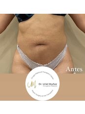 Mini Abdominoplasty - Dr Uriel Muñoz Plastic Surgeon