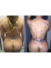 Back Liposuction - Dr. Alvar García -Reynosa Branch