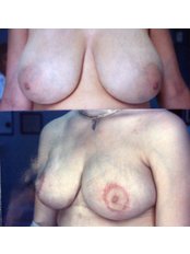 Breast Reduction - Bellezza de la Fuente