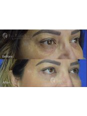 Eyelid Surgery - Baja Plastic Surgery and MedSpa Center