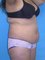 Dr. Victor  Gutierrez Plastic Surgical  Clinic - Before Tummy tuck surgery  