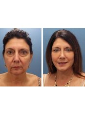 Facial Rejuvenation - Gilenis Surgical Center