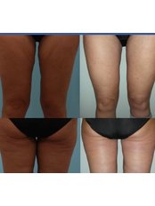 Thigh Lift - Gilenis Surgical Center
