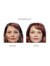 Eyelid Surgery / Blepharoplasty - Essential Aesthetics