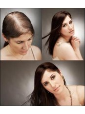 Hair Transplant - Sante Plus