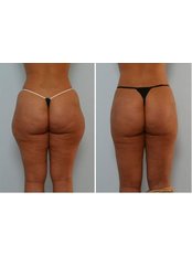 Liposuction - Sante Plus