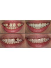 Dental Implants - Sante Plus