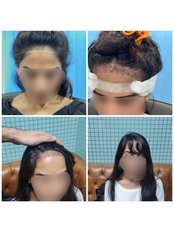 Treatment for Female Pattern Hair Loss - Cosmetic Expert