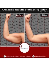 Arm Liposuction - JJ Aesthetics - Hair Transplant & Skin Clinic in Islamabad