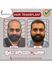 FUE - Follicular Unit Extraction - JJ Aesthetics - Hair Transplant & Skin Clinic in Islamabad