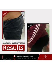 Butt Reduction - JJ Aesthetics - Hair Transplant & Skin Clinic in Islamabad