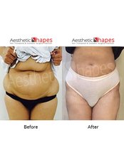 Liposuction - Aesthetic Shapes