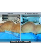 Brazilian Butt Lift - Aesthetic Shapes