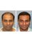 Doctor Saleem Plastic Surgeon - Hair Transplant 